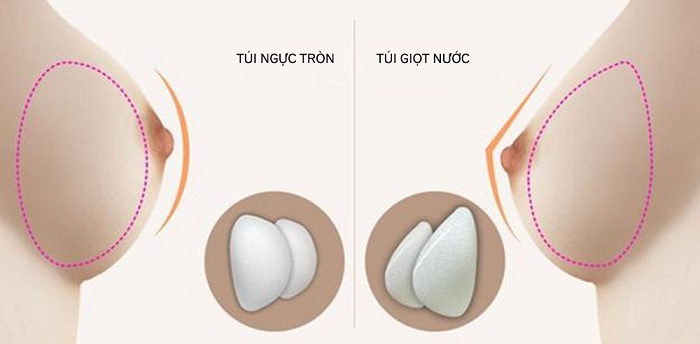 Nâng ngực gel
