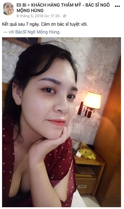 Nâng mũi ở Khánh Hòa