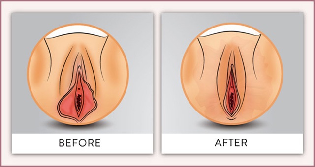 May thẩm mỹ tầng sinh môn là gì - Những điều cần biết về thẩm mỹ vùng kín