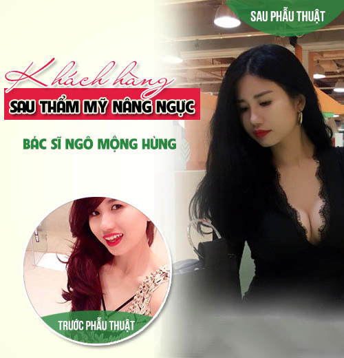 Giảm giá nâng ngực