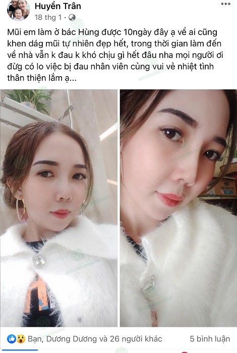 Nâng mũi bao lâu thì đẹp