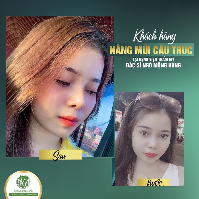 Nâng mũi bao lâu thì ổn định Nâng mũi bao lâu thì ổn định