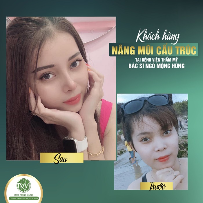 Nâng mũi đẹp ở tphcm