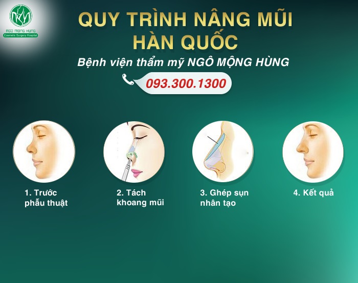 Nâng mũi Hàn Quốc