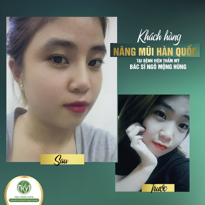 Nâng mũi Hàn Quốc
