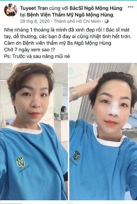 Nâng mũi gồ