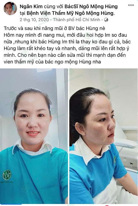 Sửa mũi hếch ở đâu