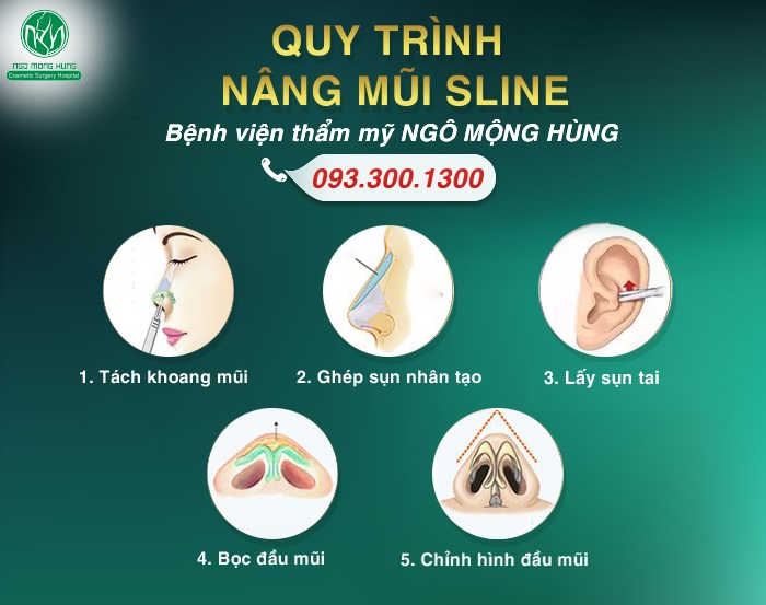 Nâng mũi S Line