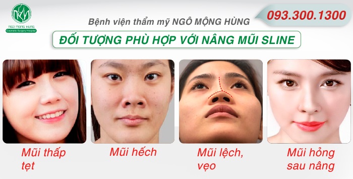 Nâng mũi S Line