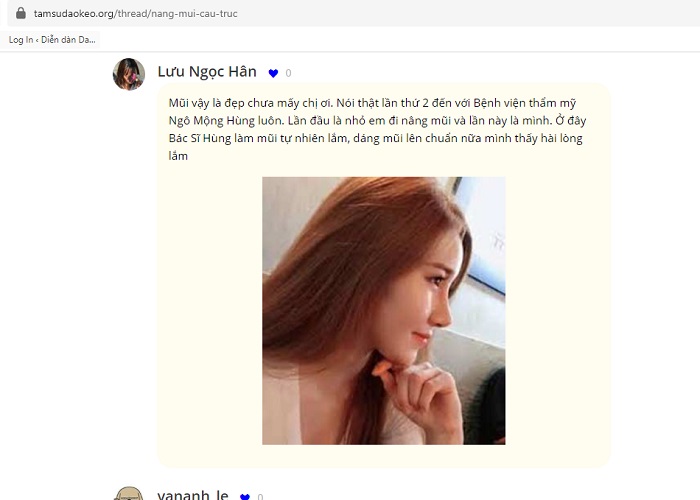 Lỗ mũi hếch lên