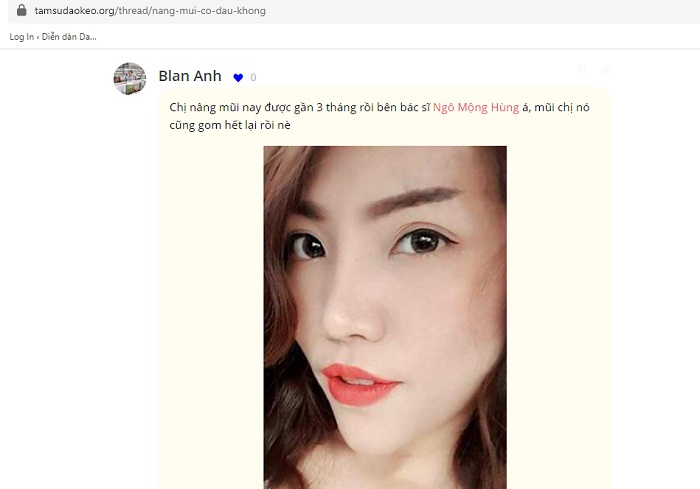 Mũi tẹt là gì