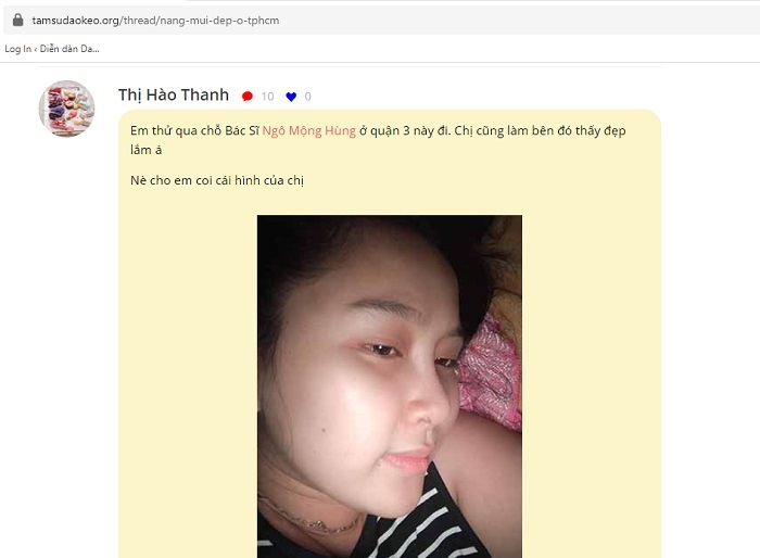 Nâng mũi S Line