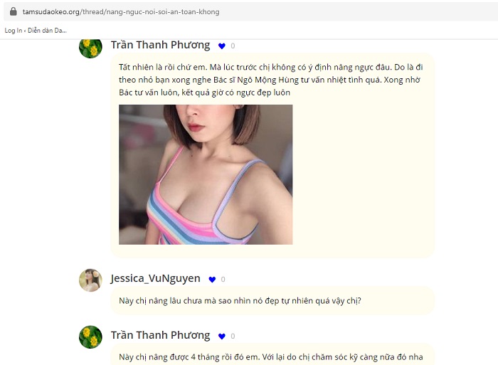 Nâng ngực hình tròn