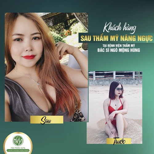 Phẫu thuật đầu ngực Phẫu thuật đầu ngực