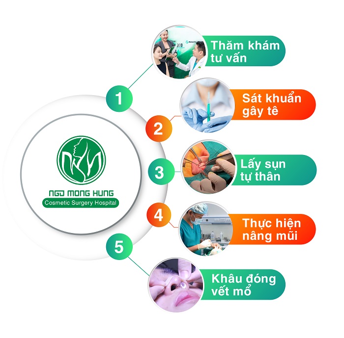 Nâng mũi S line Hàn Quốc