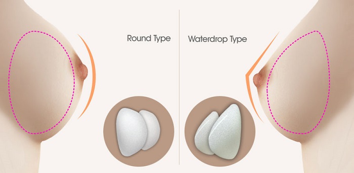 Nên lựa chọn túi ngực giọt nước hay túi ngực tròn?