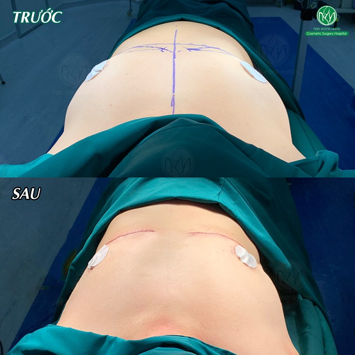 Phẫu thuật cắt bỏ ngực 