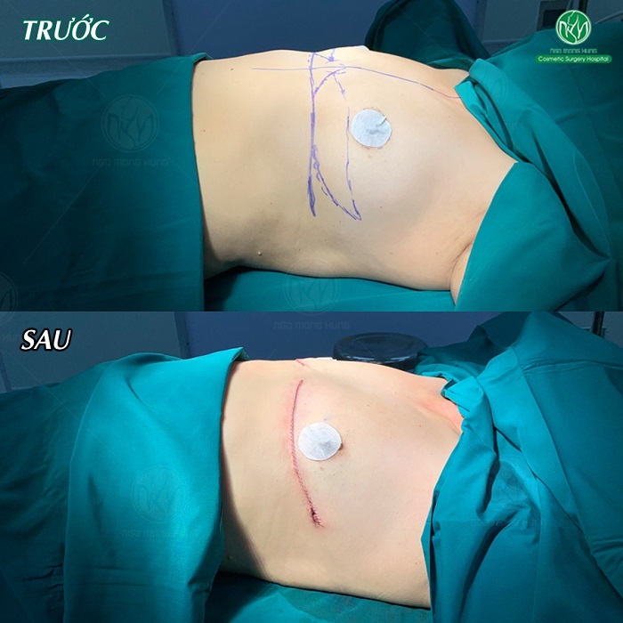 Phẫu thuật cắt bỏ ngực 