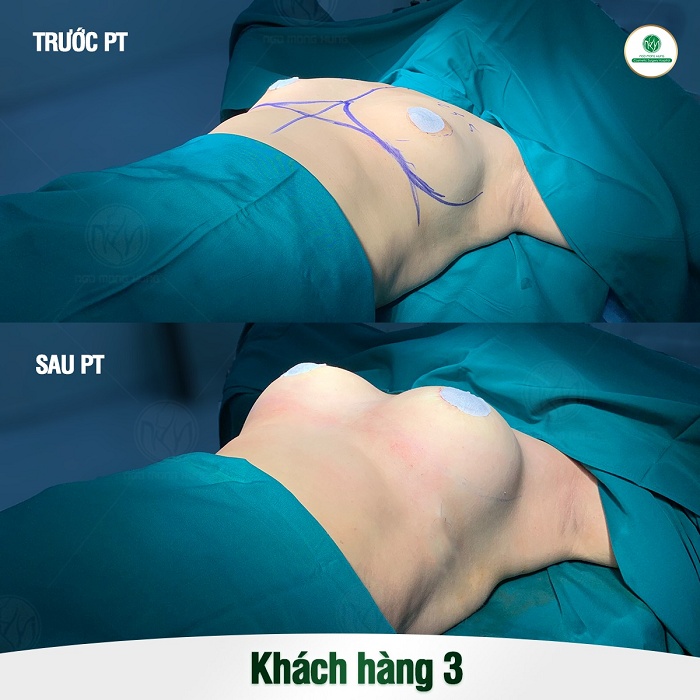Cách matxa ngực để tăng size