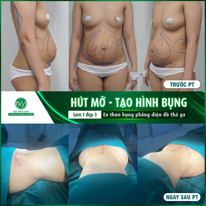 Bác sĩ hút mỡ bụng giỏi 