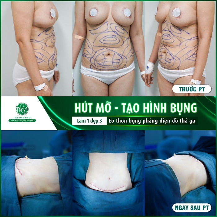 Bác sĩ hút mỡ bụng giỏi 