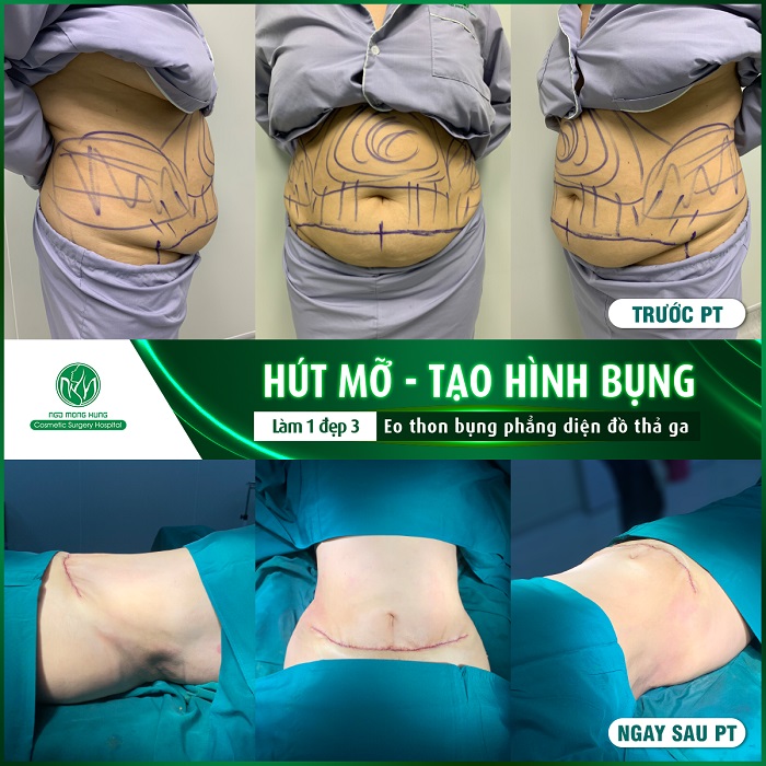 Bệnh viện hút mỡ uy tín