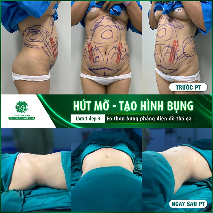 Chi phí hút mỡ bụng