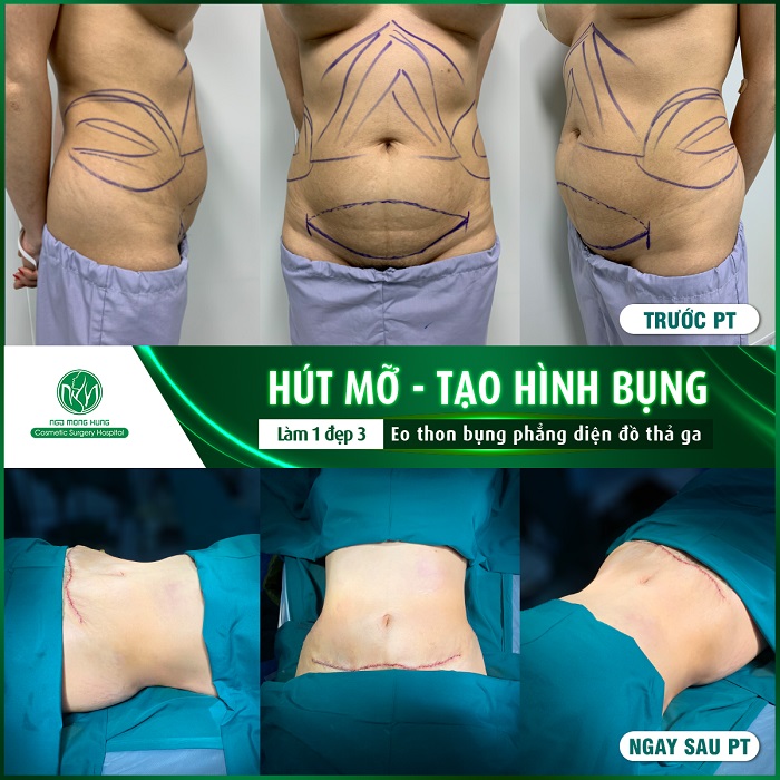 Có nên hút mỡ bụng 