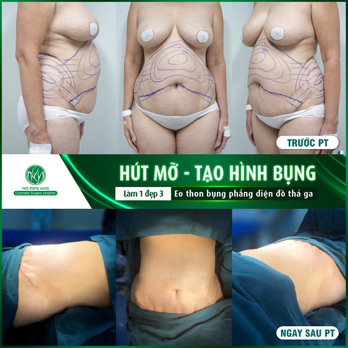 Hút mỡ có nguy hiểm không