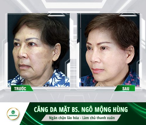 căng chỉ có tác dụng gì