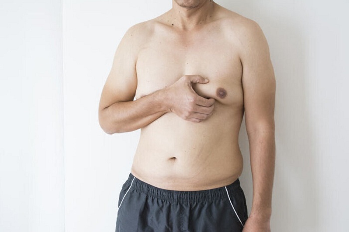 Ngực xệ ở nam giới