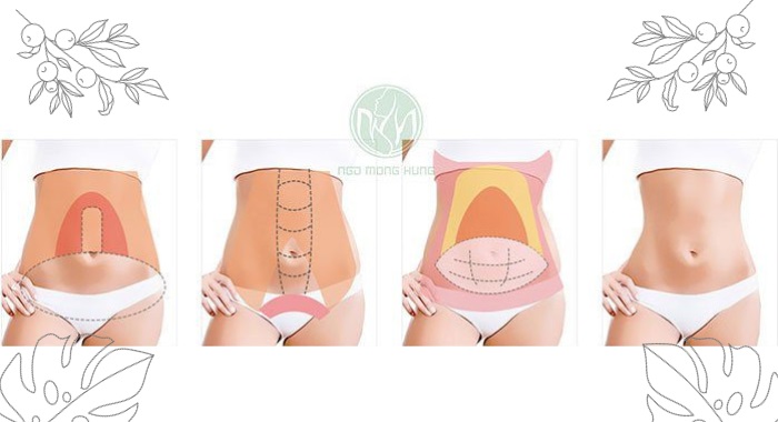 Hút mỡ bụng vòng eo 