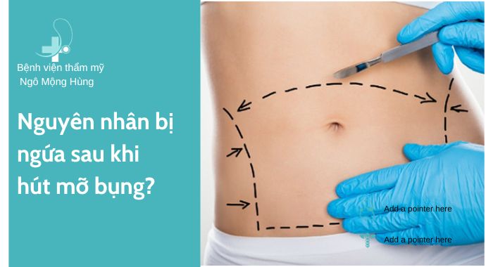  Hút mỡ bụng xong bị ngứa