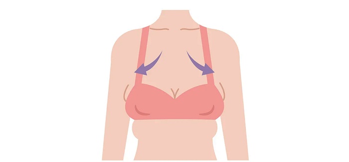 Ngực bị xệ 1 bên