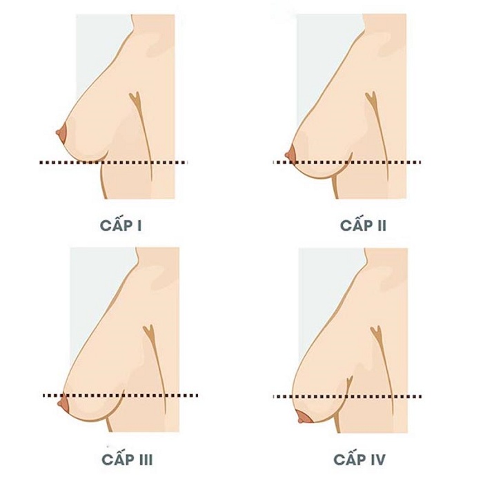 Giảm cân ngực bị xệ