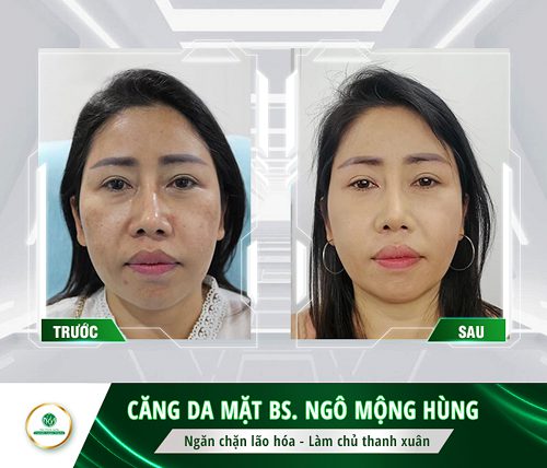 làm trắng da mặt bằng mật ong