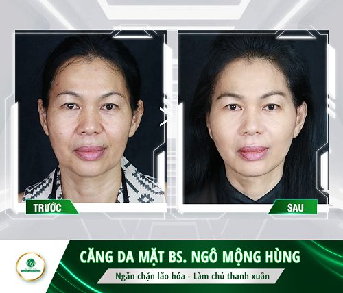 tác dụng của cấy chỉ nâng cơ mặt tác dụng của cấy chỉ nâng cơ mặt