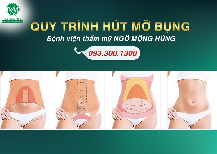 Quy trình hút mỡ bụng