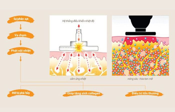 Chi phí giảm mỡ bụng bằng Laser Lipo