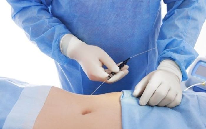 Công nghệ giảm mỡ bụng tốt nhất hiện nay