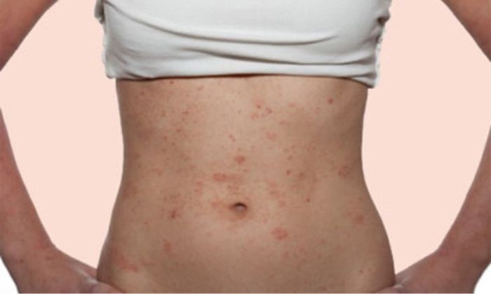 Giảm mỡ bụng bằng sóng siêu âm có tốt không