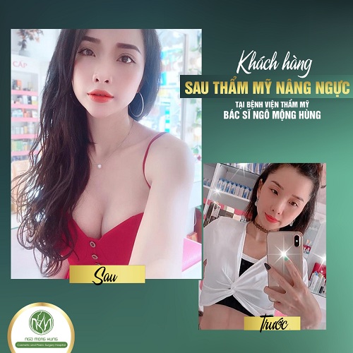 Thuốc nở ngực lady giá bao nhiêu