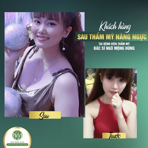 Bài tập tăng vòng 1 ở tuổi dậy thì