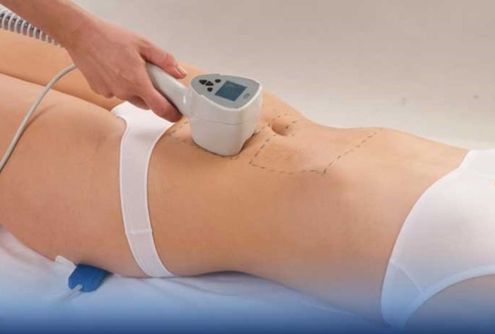 Hút mỡ bụng công nghệ Lipo Ultrasound