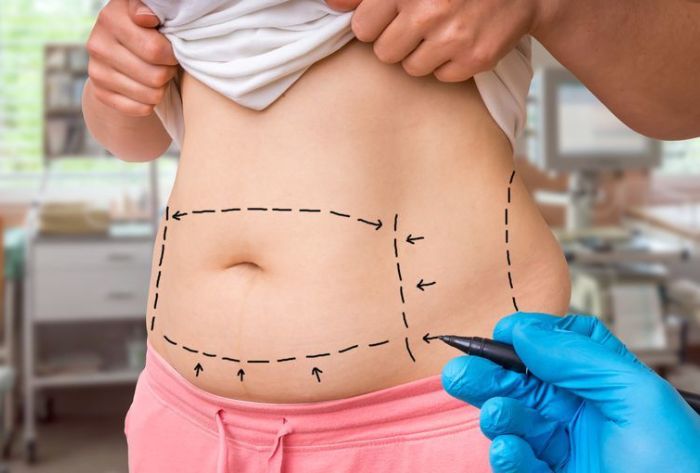 Hút mỡ bụng Lipo Ultrasound có tốt không