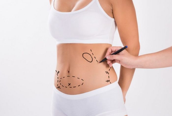 Hút mỡ bụng Vaser Lipo