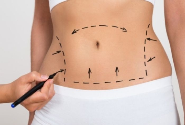 Hút mỡ bụng Lipo Ultrasound giá bao nhiêu