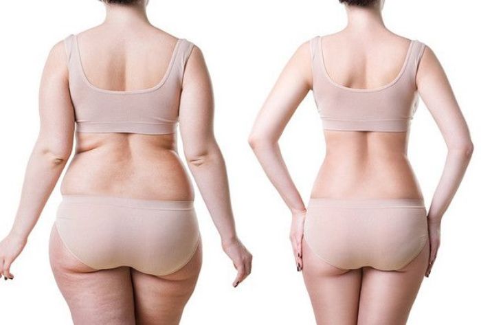 Hút mỡ lưng mặc áo định hình bao lâu