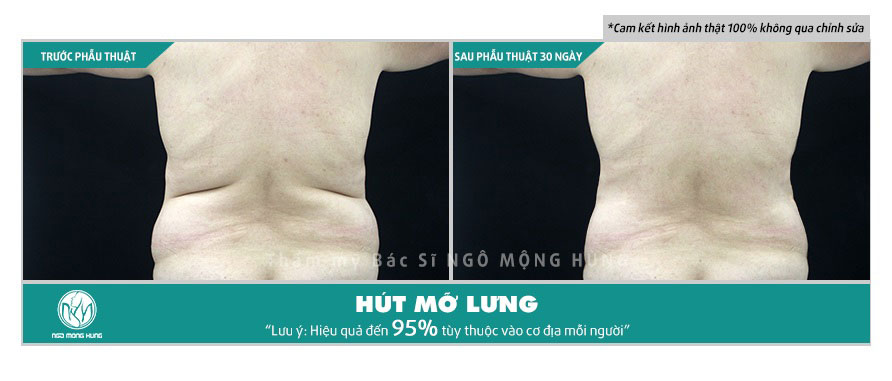Hút mỡ lưng nách
