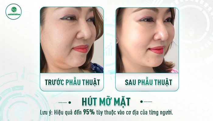 Hút mỡ mặt hết bao nhiêu tiền